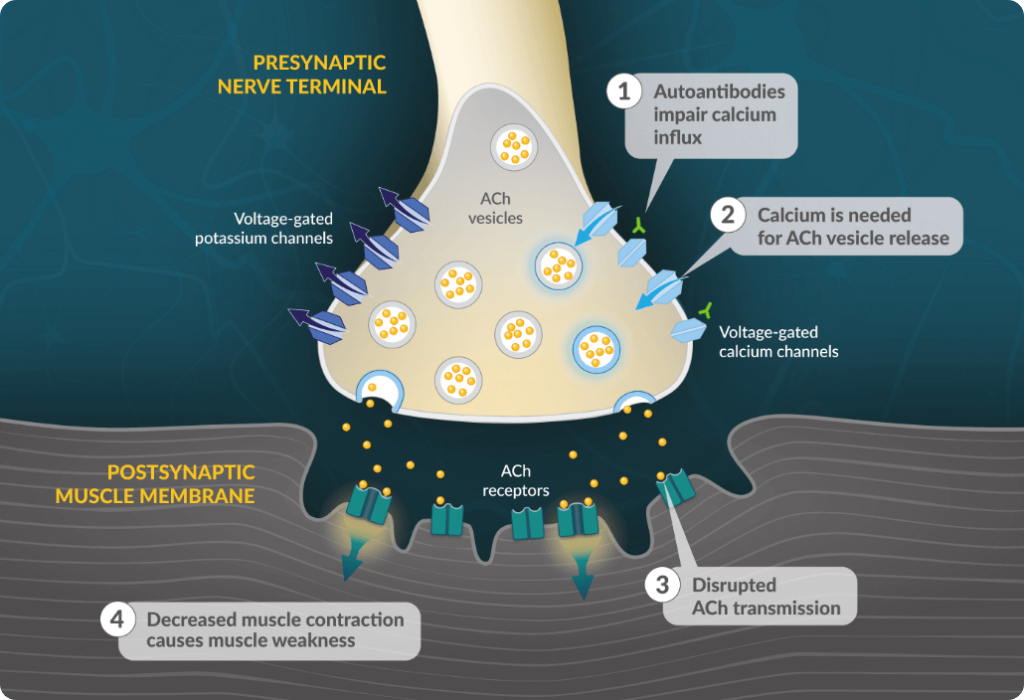 Diagram showing the neuromuscular junction in LEMS - explaining the pathophysiology of LEMS